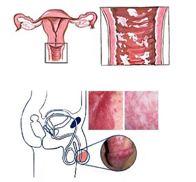 female and male genital candidiasis as a cause of pathological discharge